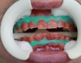 Процедура отбеливания зубов с ведением фотопротокола